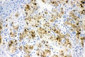 IHC analysis of ADH1A using anti- ADH1A antibody . (ADH1A antibody  (AA 213-375))