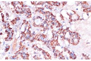 Immunohistochemistry of paraffin-embedded Human thyroid cancer using MRPL23 Polyclonal Antibody at dilution of 1:100 (40x lens). (MRPL23 antibody)