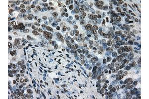 Immunohistochemical staining of paraffin-embedded Adenocarcinoma of colon tissue using anti-L1CAMmouse monoclonal antibody. (L1CAM antibody)