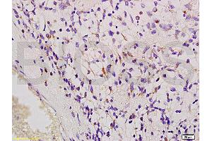 Formalin-fixed and paraffin embedded human esophageal cancer labeled with Anti-MSR1/CD204 Polyclonal Antibody, Unconjugated (ABIN872905) at 1:200, followed by conjugation to the secondary antibody and DAB staining