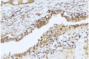ABIN6275349 at 1/100 staining Human lung cancer tissue by IHC-P.