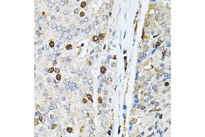 Immunohistochemistry of paraffin-embedded human prostate cancer using PNKP antibody (ABIN2564598) at dilution of 1:100 (40x lens). (PNKP antibody)