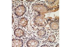 Immunohistochemical analysis of STEAP2 staining in human colon cancer formalin fixed paraffin embedded tissue section. (STEAP2 antibody  (C-Term))