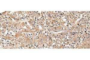Immunohistochemistry of paraffin-embedded Human liver cancer tissue using LEPR Polyclonal Antibody at dilution of 1:30(x200) (Leptin Receptor antibody)
