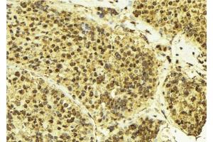 ABIN6276492 at 1/100 staining Human breast cancer tissue by IHC-P. (Cullin 3 antibody  (Internal Region))
