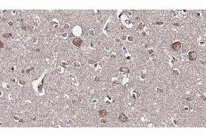 ABIN6277595 at 1/100 staining Human brain cancer tissue by IHC-P. (GDI1 antibody  (Internal Region))