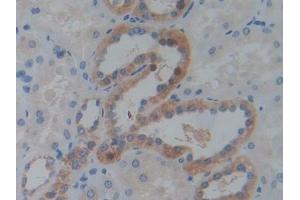 Immunohistochemistry (IHC) image for anti-Insulin-Like Growth Factor 2 mRNA Binding Protein 3 (IGF2BP3) (AA 2-343) antibody (ABIN1868507)