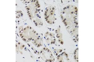 Immunohistochemistry of paraffin-embedded human gastric cancer using EDF1 antibody. (EDF1 antibody)