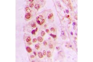 Immunohistochemical analysis of LIMK2 staining in human lung cancer formalin fixed paraffin embedded tissue section. (LIMK2 antibody  (Center))