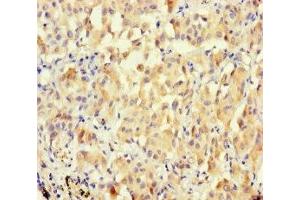 Immunohistochemistry of paraffin-embedded human lung cancer using ABIN7166679 at dilution of 1:100 (BPESC1 antibody  (AA 1-116))