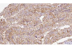 ABIN6273304 at 1/100 staining Human thyroid cancer tissue by IHC-P. (RAB14 antibody  (C-Term))