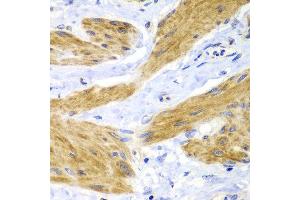 Immunohistochemistry of paraffin-embedded human gastric cancer using HRas antibody at dilution of 1:100 (40x lens). (HRAS antibody)