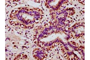 IHC image of ABIN7155709 diluted at 1:100 and staining in paraffin-embedded human breast cancer performed on a Leica BondTM system. (Homeobox A11 antibody  (AA 115-176))