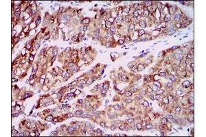 Immunohistochemical analysis of paraffin-embedded liver cancer tissues using CCL2 mouse mAb with DAB staining. (CCL2 antibody)