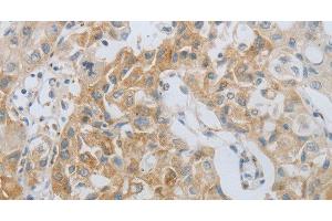 Immunohistochemistry of paraffin-embedded Human lung cancer using MMP25 Polyclonal Antibody at dilution of 1:80 (MMP25 antibody)