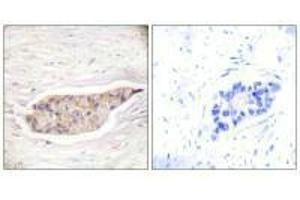 Immunohistochemical analysis of paraffin-embedded human breast carcinoma tissue using Annexin A6 antibody. (ANXA6 antibody)