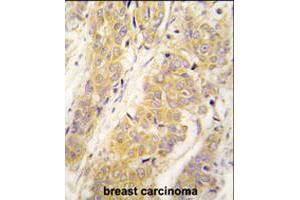 Formalin-fixed and paraffin-embedded human breast carcinoma tissue reacted with PKM2 polyclonal antibody  , which was peroxidase-conjugated to the secondary antibody, followed by DAB staining . (PKM2 antibody  (AA 483-513))