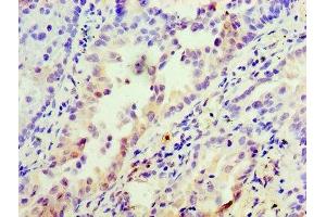 Immunohistochemistry of paraffin-embedded human lung cancer using ABIN7156235 at dilution of 1:100 (INHBA antibody  (AA 311-426))