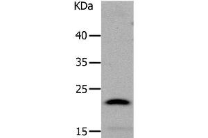 Western Blot analysis of Human liver cancer tissue using LCN2 Polyclonal Antibody at dilution of 1:1050 (Lipocalin 2 antibody)