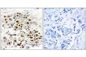 Immunohistochemistry analysis of paraffin-embedded human breast carcinoma tissue, using MAP3K6 antibody.