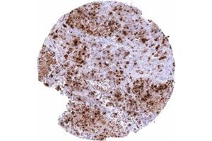 Esophagus Neuroendocrine carcinoma with strong somatostatin immunostaining of tumor cells (Recombinant Somatostatin antibody)