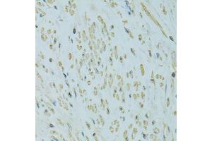 Immunohistochemistry of paraffin-embedded human uterine cancer using UGT1A6 antibody (ABIN4905553) at dilution of 1:100 (40x lens). (UGT1A6 antibody)