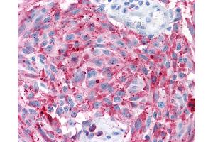 Anti-MRGD / MRGPRD antibody IHC of human Skin, Melanoma. (MRGPRD antibody  (Extracellular Domain))