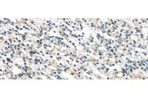 Immunohistochemistry of paraffin-embedded Human prostate cancer tissue using VPS36 Polyclonal Antibody at dilution 1:40 (VPS36 antibody)