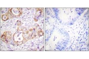 Immunohistochemistry analysis of paraffin-embedded human colon carcinoma, using Keratin 8 (Phospho-Ser432) Antibody. (KRT8 antibody  (pSer432))