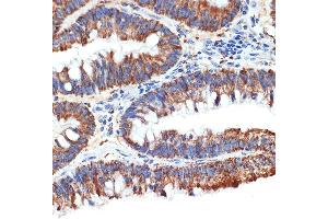 Immunohistochemistry of paraffin-embedded human colon carcinoma using P Rabbit mAb (ABIN1682842, ABIN3019312, ABIN3019313 and ABIN7101749) at dilution of 1:100 (40x lens). (PAWR antibody)