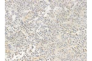 ABIN6256291 and ABIN6267489 at 1/100 staining human non-Hodgkin lymphoma by IHC-P. (Aryl Hydrocarbon Receptor antibody  (pSer36))