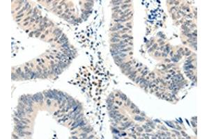 The image on the left is immunohistochemistry of paraffin-embedded Human colon cancer tissue using ABIN7192880(TRAF7 Antibody) at dilution 1/20, on the right is treated with synthetic peptide. (TRAF7 antibody)