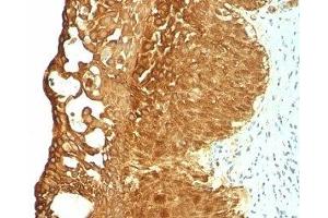Formalin-fixed, paraffin-embedded human cervical carcinoma stained with Cytokeratin 19 antibody (KRT19/799) (Cytokeratin 19 antibody)