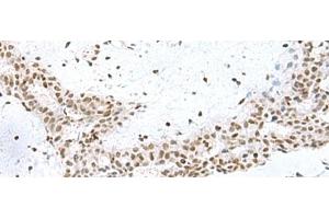 Immunohistochemistry of paraffin-embedded Human breast cancer tissue using PUM3 Polyclonal Antibody at dilution of 1:80(x200)