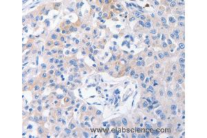 Immunohistochemistry of Human lung cancer using SLC10A1 Polyclonal Antibody at dilution of 1:31 (SLC10A1 antibody)