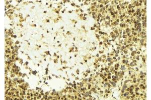 ABIN6277627 at 1/100 staining Human breast cancer tissue by IHC-P. (Plakophilin 2 antibody  (N-Term))
