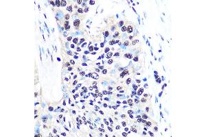Immunohistochemistry of paraffin-embedded human esophageal cancer using NONO/p54nrb Rabbit mAb (ABIN7268947) at dilution of 1:100 (40x lens). (NONO antibody)