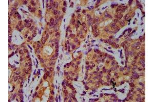 IHC image of ABIN7143840 diluted at 1:400 and staining in paraffin-embedded human liver cancer performed on a Leica BondTM system. (AASS antibody  (AA 224-364))