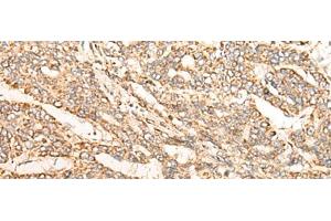 Immunohistochemistry of paraffin-embedded Human liver cancer tissue using GATD3B Polyclonal Antibody at dilution of 1:35(x200) (C21orf33 antibody)