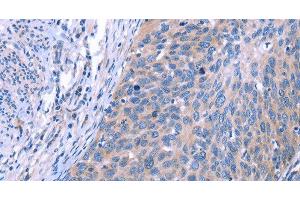 Immunohistochemistry of paraffin-embedded Human cervical cancer using ESPL1 Polyclonal Antibody at dilution of 1:40 (Separase antibody)