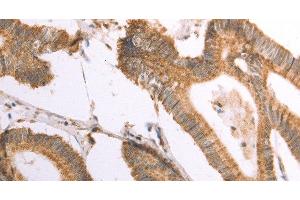 Immunohistochemistry of paraffin-embedded Human colon cancer using NAMPT Polyclonal Antibody at dilution of 1:30 (NAMPT antibody)