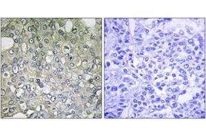 Immunohistochemistry analysis of paraffin-embedded human breast carcinoma tissue, using ADRA1D Antibody. (ADRA1D antibody  (AA 451-500))