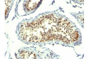 Formalin-fixed, paraffin-embedded human Testicular Carcinoma stained with Thymidylate Synthase Monoclonal Antibody (TMS715). (TYMS antibody)