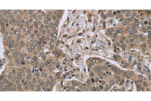 Immunohistochemistry of paraffin-embedded Human liver cancer tissue using IL15RA Polyclonal Antibody at dilution 1:45