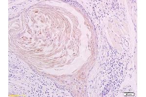 Formalin-fixed and paraffin embedded human oral squamous cell carcinoma labeled with Anti LYVE-1 Polyclonal Antibody, Unconjugated (ABIN674799) at 1:200 followed by conjugation to the secondary antibody and DAB staining (LYVE1 antibody  (AA 231-318))