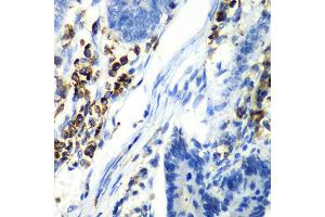 Immunohistochemistry of paraffin-embedded human colon carcinoma using ASGR1 antibody at dilution of 1:100 (x40 lens).