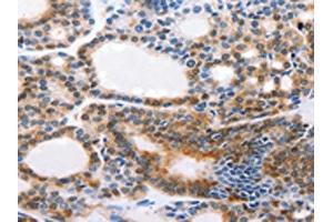 The image on the left is immunohistochemistry of paraffin-embedded Human thyroid cancer tissue using ABIN7190308(CMTM3 Antibody) at dilution 1/20, on the right is treated with synthetic peptide.