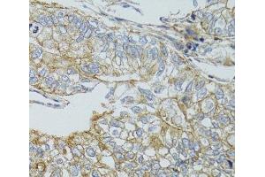 Immunohistochemistry of paraffin-embedded Human gastric cancer using CHMP4B Polyclonal Antibody at dilution of 1:100 (40x lens). (CHMP4B antibody)