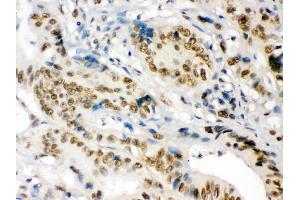 nmt55/p54nrb was detected in paraffin-embedded sections of human intestinal cancer tissues using rabbit anti- nmt55/p54nrb Antigen Affinity purified polyclonal antibody at 1 μg/mL.