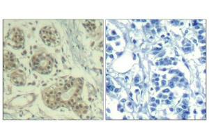 Immunohistochemical analysis of paraffin-embedded human breast carcinoma tissue using MDM2(Phospho-Ser166) Antibody(left) or the same antibody preincubated with blocking peptide(right). (MDM2 antibody  (pSer166))
